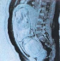 Pelvimetría. ¿Qué es?