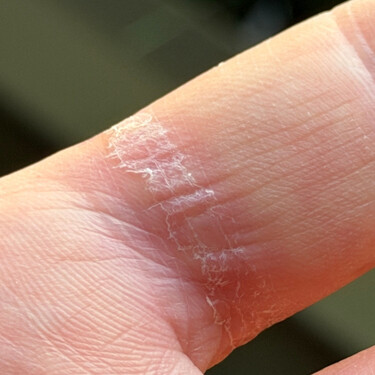 Samsung Galaxy Ring Dedo Herido