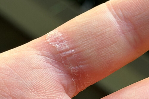 El anillo inteligente de Samsung deja marca, pero no de la forma que esperas: un usuario relata su pesadilla