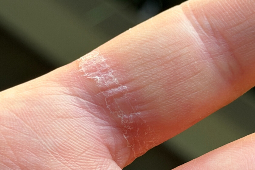 La gallina de los huevos de oro de Samsung se convierte en una pesadilla para los dedos y la salud