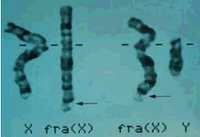 Un paso más en la cura del Síndrome X Frágil