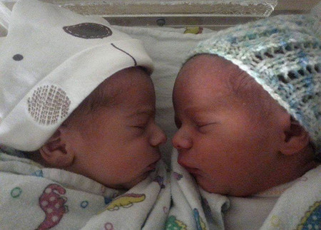 Gemelos cordón umbilical