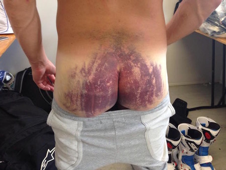 SBK Australia 2015: la dolorosa marca con la que corrió Randy De Puniet