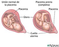Complicaciones de la placenta