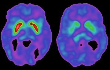 Una nueva molécula contra el Parkinson