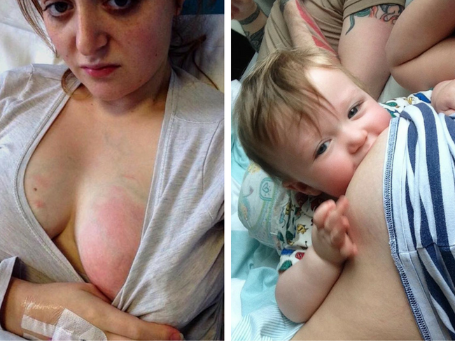 Esto es una mastitis: una madre comparte su dolorosa experiencia para que las madres lactantes se informen