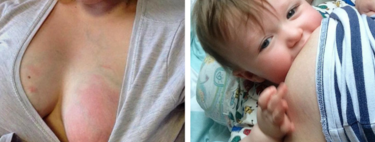 Esto es una mastitis: una madre comparte su dolorosa experiencia para que las madres lactantes se informen