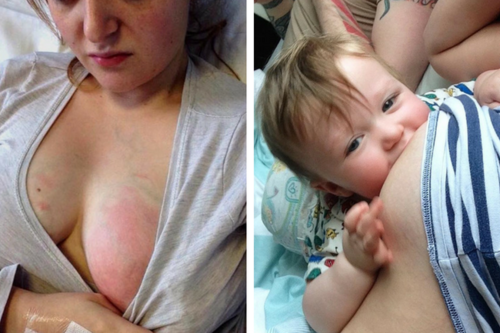 Esto es una mastitis: una madre comparte su dolorosa experiencia para que las madres lactantes se informen
