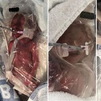 Estas trillizas británicas son las más prematuras del mundo: nacieron con 22 semanas y 1.284 gramos entre las tres 