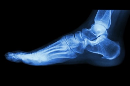 Cuándo es necesaria la radiografía en un esguince de tobillo