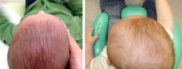 Plagiocefalia: ¿Cómo prevenir y tratar la cada vez más frecuente deformidad de cabeza de los bebés?