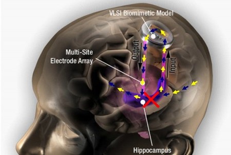 ¿Existen prótesis de cerebro biónica?