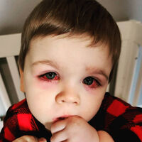 Una madre advierte sobre las bacterias en los juguetes de baño que causaron una grave infección en los ojos de su bebé