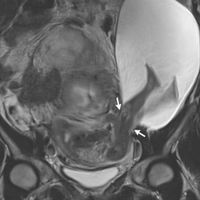 El increíble embarazo de un bebé que atravesó el útero con sus piernas