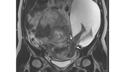 El increíble embarazo de un bebé que atravesó el útero con sus piernas