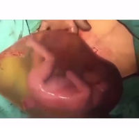 El asombroso vídeo viral de un bebé dando pataditas dentro del saco amniótico después del parto