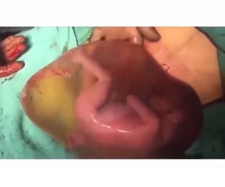 El asombroso vídeo viral de un bebé dando pataditas dentro del saco amniótico después del parto