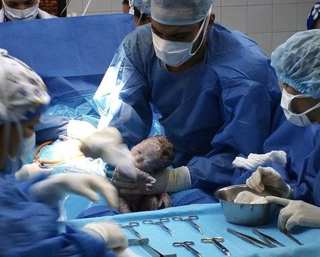 El método Misgav Ladach: la cesárea rápida