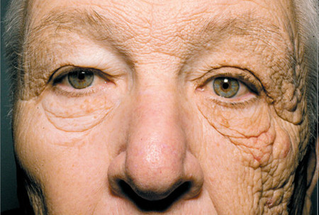 Dermatoheliosis unilateral