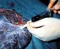 El cordón umbilical donado de forma altruista