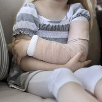 Fracturas de huesos en niños: cuáles son las más frecuentes y cómo se tratan 