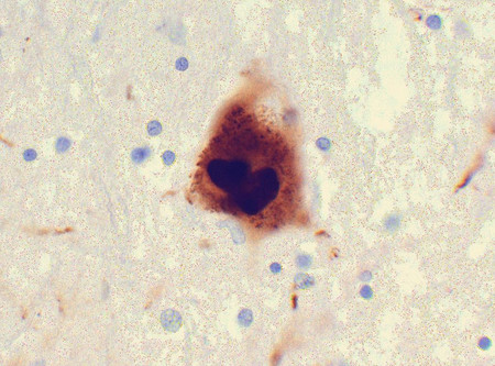 La eliminación del apéndice reduce el riesgo de enfermedad de Parkinson
