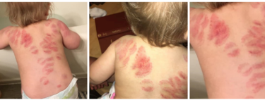 Recoge a su bebé en la guardería y la encuentra llena de mordeduras: qué hacer ante un caso así