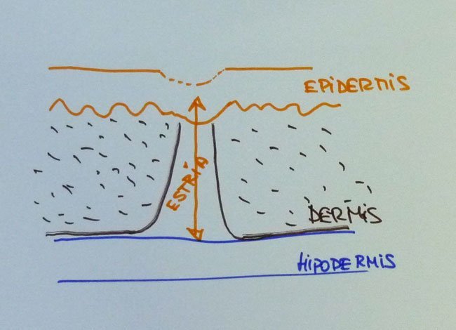 Cómo se forman las estrías de distensión en la piel de la embarazada