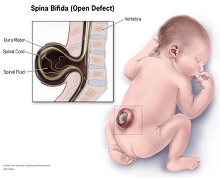 Spina Bifida Web