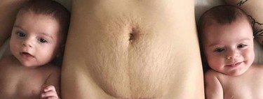 "Tus estrías no te definen, tu cicatriz no te define", la importancia de quererse tras el parto