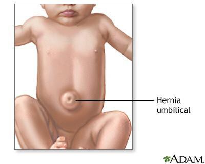 hernia-umbilical