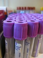 La amniocentesis será, a la larga, reemplazada por un simple análisis de sangre de la madre