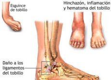 hematoma subiendo la pierna
