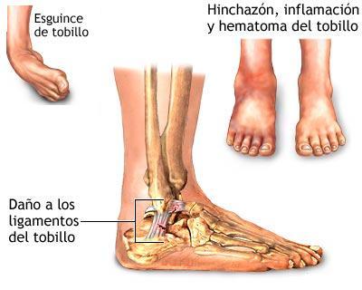 El esguince de tobillo (I): qué es y tipos según gravedad