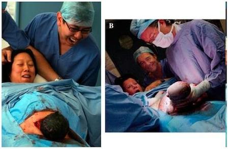 La cesárea "natural": una técnica centrada en la mujer