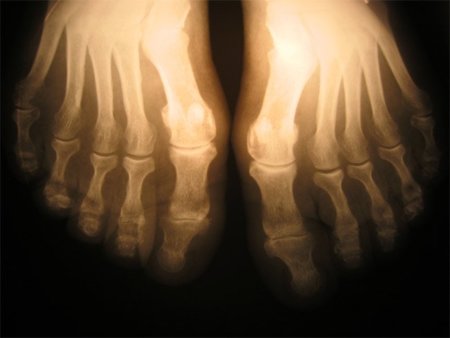 Un estudio da un paso más sobre la osteoporosis en los hombres