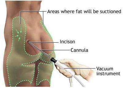 La liposucción o el camino fácil para adelgazar