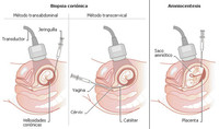 Pruebas prenatales V: Biopsia coriónica