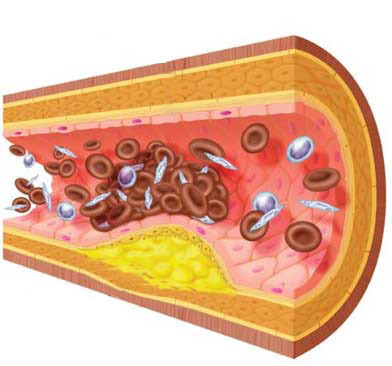 Dieta para prevenir la Arterioesclerosis