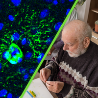 El alzhéimer empieza antes de los síntomas que conocemos y una proteína puede cambiar todo 