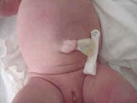 Cuidados del ombligo