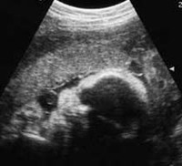 En qué casos se realiza una ecocardiografía fetal