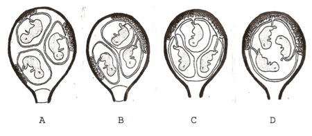 embarazo-gemelar-triple