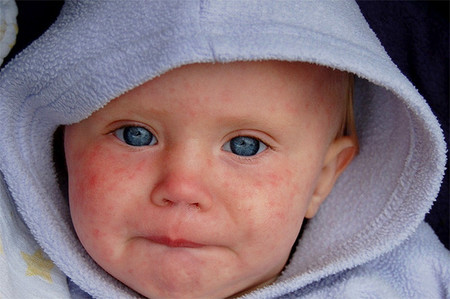 Una comunidad antivacunas de Holanda sufre una epidemia de sarampión (otra vez)