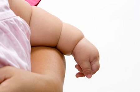 Nacer por cesárea aumenta el riesgo de obesidad infantil