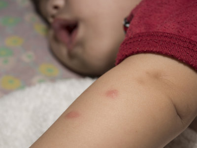Picaduras de mosquitos, cómo proteger a los niños 