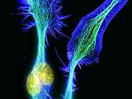 Menos posibilidades de sufrir esclerosis múltiple con la exposición solar durante la infancia