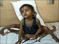 Una niña-diosa con 4 brazos y 4 piernas. Los casos de gemelos-siameses.