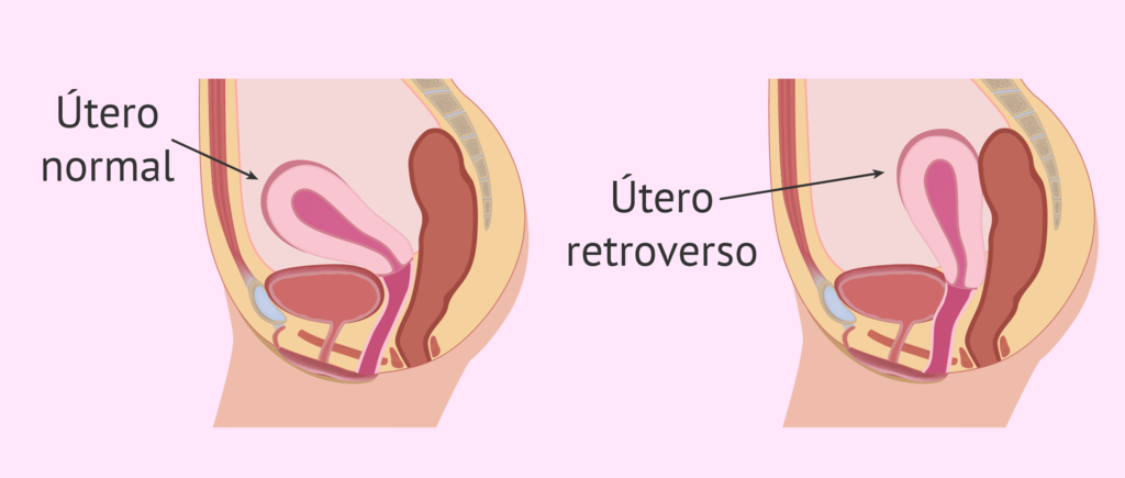 Útero invertido o útero al revés y embarazo