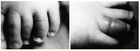 Sindrome del torniquete por pelo o hilo